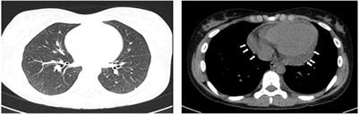 Case Report: Severe Eosinophilic Asthma Associated With ANCA-Negative EGPA in a Young Adult Successfully Treated With Benralizumab